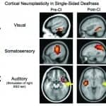 Cortical Neuroplasticity in Hearing Loss: Why It Matters in Clinical Decision-Making for Children and Adults
