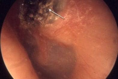 Study Shows That Pathology Tests Not Needed for Middle Ear Cyst Removal