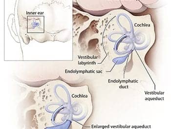 NIH Researchers Find DNA ‘Fingerprint’ Associated with Enlarged Vestibular Aqueduct