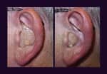 Design of a Directional Half-Shell Hearing Aid